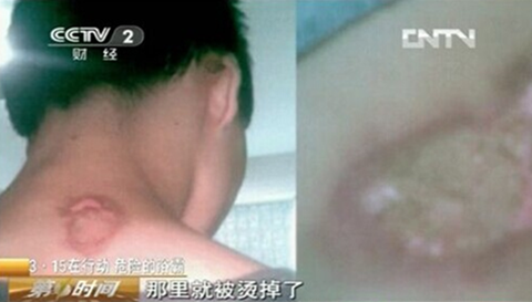 浴霸烫伤皮肤